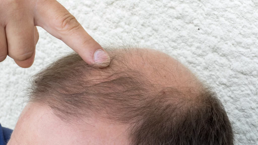 sposoby radzenia sobie z łysieniem androgenowym