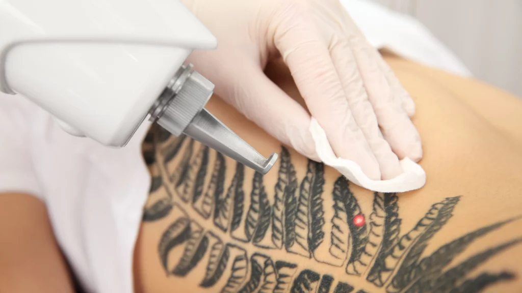 co trzeba wiedzieć o usuwaniu tatuaży