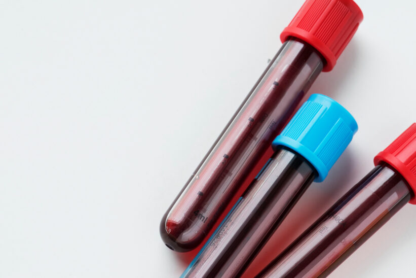 3 probówki z krwią wykorzystywane w diagnostyce niedoboru witaminy B12 u seniorów